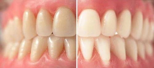使用竹炭牙刷-前后牙齿黄白对比.jpg